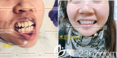 北京薇琳张建峰医生半隐形牙齿矫正案例