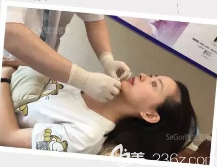 注射乔雅登玻尿酸丰下巴过程中