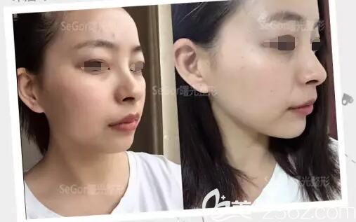 术后三天玻尿酸丰下巴和术前对比