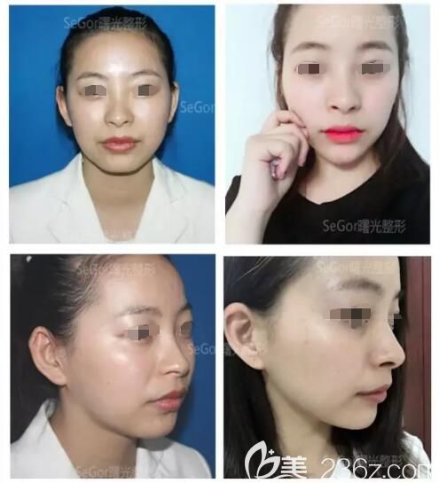 到常州曙光玻尿酸丰下巴术前术后对比案例
