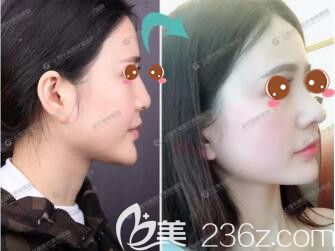 上海华美医疗美容医院方脸隆鼻标准