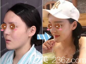 <!--<i data=20240703-sp></li>
<li><i data=20240703-sp></i>-->华美医疗美容医院圆脸隆鼻标准