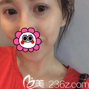 北京叶美人医疗美容诊所双眼皮修复案例