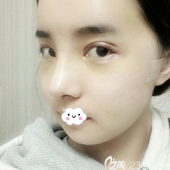 韩国原辰鼻综合+自体脂肪面部填充术后效果