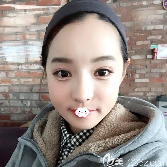 韩国原辰鼻综合+自体脂肪丰面术后20天真实恢复图