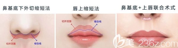 韩国AD爱慕三大隐形无痕人中缩短术