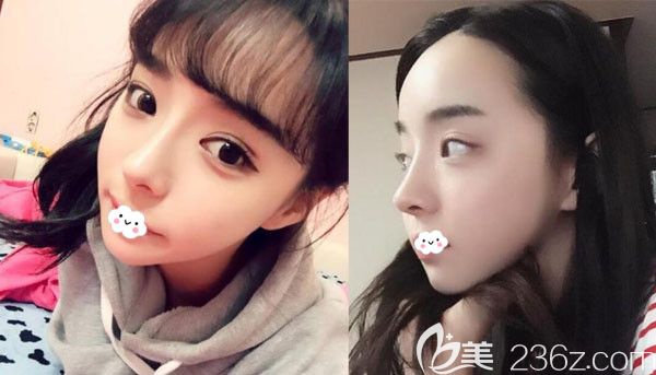 韩国原辰鼻综合隆鼻+自体脂肪丰面半年恢复效果图