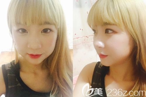 在韩国id双鄂手术+颧骨缩小术后1个月 在韩国id双鄂手术+颧骨缩小术后1个月