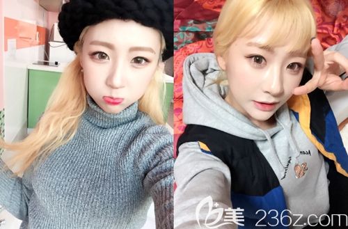 在韩国id双鄂手术+颧骨缩小术后6个月 在韩国id双鄂手术+颧骨缩小术后6个月