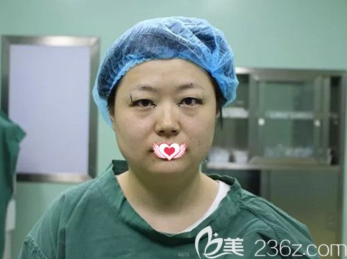 唐春香主任为我术前做双眼皮手术设计