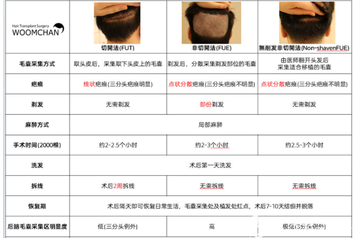 【韩国永长植发医院】切开法(FUT) & 非切开法 (FUE) & 无削发非切开法 (Non-shavenFUE) 【韩国永长植发医院】切开法(FUT) & 非切开法 (FUE) & 无削发非切开法 (Non-shavenFUE)