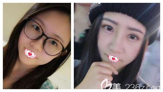 杨鹏主任双眼皮手术案例