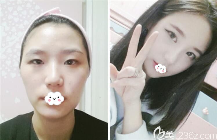 韩国乐得千成俊面部轮廓+韩式无痕双眼皮+假体隆鼻案例效果对比图 韩国乐得千成俊面部轮廓+韩式无痕双眼皮+假体隆鼻案例效果对比图