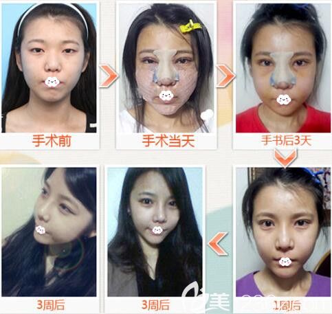 韩国乐得整形医院鼻综合隆鼻+双眼皮+面部轮廓整形案例恢复过程图