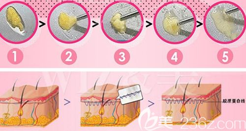 韩国WIZ&美吸脂手术过程