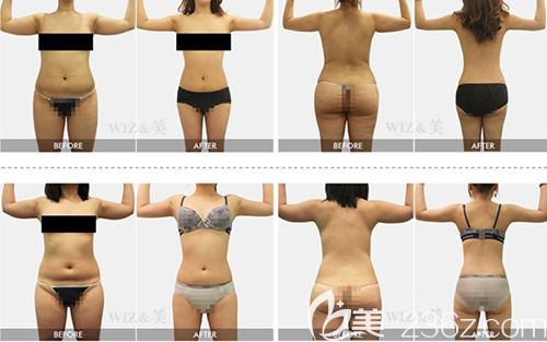 WIZ&美吸脂前后对比案例