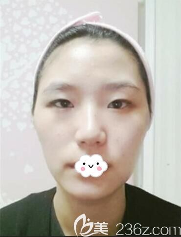 韩国乐得red整形外科做韩式无痕双眼皮+隆鼻+面部轮廓整形真人案例 韩国乐得red整形外科做韩式无痕双眼皮+隆鼻+面部轮廓整形真人案例