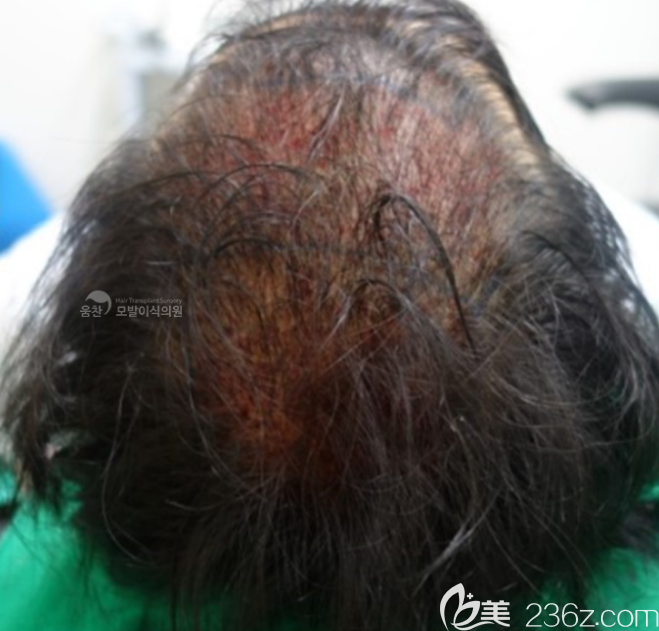植发术后
