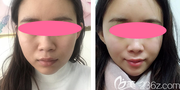 分享我在赣州韩美整形瘦脸一个月前后对比图 分享我在赣州韩美整形瘦脸一个月前后对比图