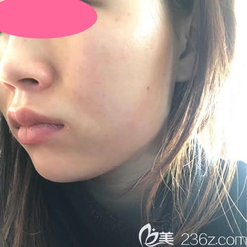 在赣州韩美整形注射瘦脸第5天效果 在赣州韩美整形注射瘦脸第5天效果