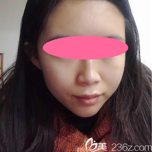 在赣州韩美注射瘦脸术后第10天效果 在赣州韩美注射瘦脸术后第10天效果