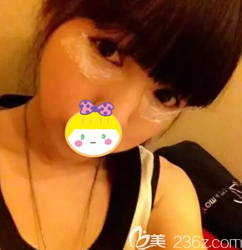 玻尿酸丰卧蚕术前敷麻药 玻尿酸丰卧蚕术前敷麻药