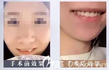 李俊峰牙齿矫正案例 李俊峰牙齿矫正案例