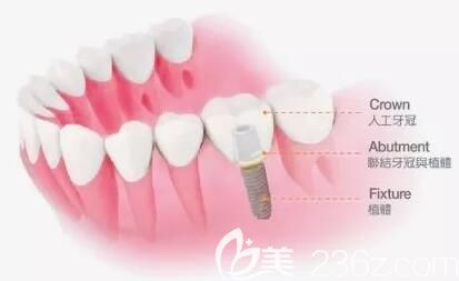 李俊峰分享种植牙 李俊峰分享种植牙