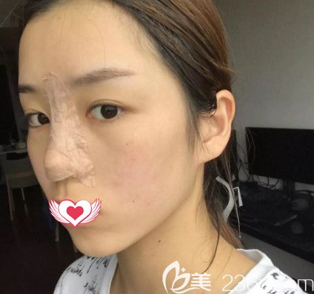 在石家庄雅芳亚做鼻综合术后3天鼻子微肿