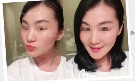 刚注射完瘦脸除皱瘦脸天