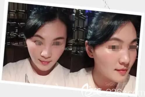 分享瘦脸除皱瘦脸术后三天蜕变