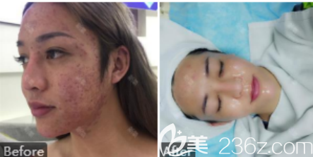 激光治疗痘坑的案例一