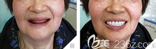 沈阳欢乐口孙乃鹤医生全口种植牙案例对比图 沈阳欢乐口孙乃鹤医生全口种植牙案例对比图