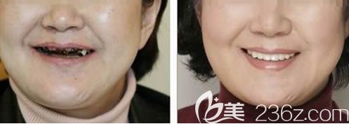 沈阳欢乐口腔徐阳院长全口即刻种植牙前后对比效果 沈阳欢乐口腔徐阳院长全口即刻种植牙前后对比效果