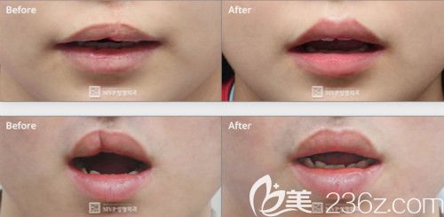 韩国mvp崔宇植院长修复二期唇裂疤痕