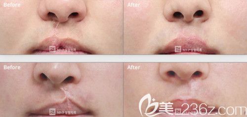 韩国mvp崔宇植院长修复二期人中疤痕