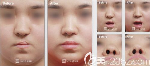 韩国mvp崔宇植院长修复二期唇裂鼻