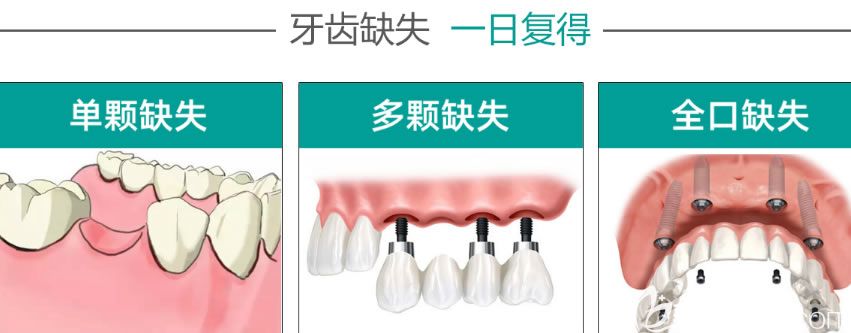 沈阳欢尔口腔即刻种植牙优势