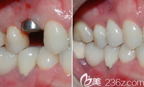 欢乐口腔沈阳分院张桂静医生单颗牙缺失种植案例