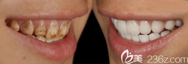 沈阳欢乐口腔韩竹医生牙齿贴面修复前后对比图 沈阳欢乐口腔韩竹医生牙齿贴面修复前后对比图