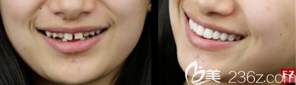 26岁刘女士做完瓷贴面前后对比照 26岁刘女士做完瓷贴面前后对比照