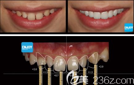 33岁的白女士让彭医生做完DSD美学瓷贴面后的对比效果 33岁的白女士让彭医生做完DSD美学瓷贴面后的对比效果