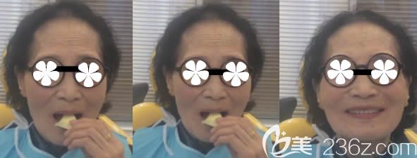 张女士选择吸附性全口义齿后的效果图 张女士选择吸附性全口义齿后的效果图