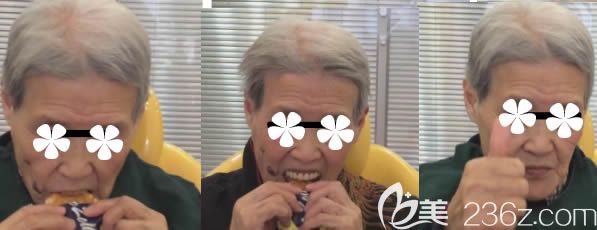 刘女士做完BPS生物功能性全口义齿后的效果 刘女士做完BPS生物功能性全口义齿后的效果