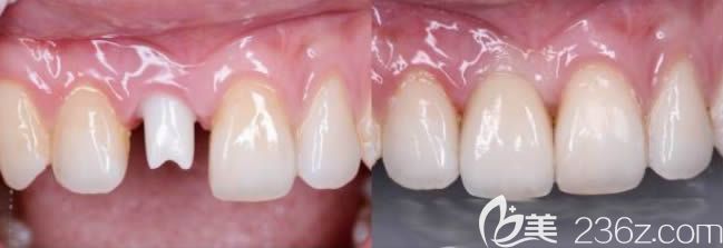 沈阳欢乐口腔李春玲医生前门牙全瓷冠修复效果图 沈阳欢乐口腔李春玲医生前门牙全瓷冠修复效果图