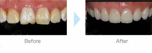 沈阳欢乐口腔尹医生茶渍牙选择做全瓷美学修复后的对比照片 沈阳欢乐口腔尹医生茶渍牙选择做全瓷美学修复后的对比照片