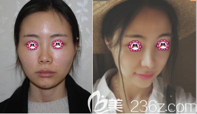 北京美丽有约杜太超鼻综合隆鼻案例
