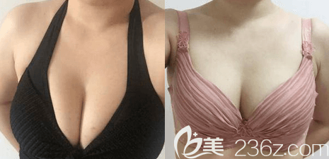 北京<!--<i data=20240703-sp></i>--><!--<i data=20240703-sp></i>-->缩胸手术