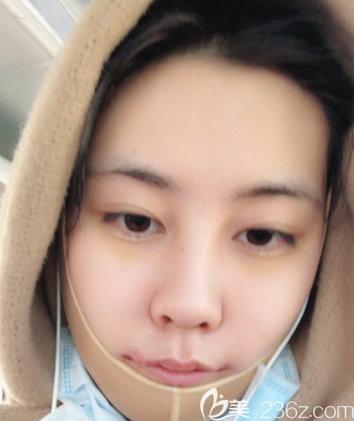 刚拆完胶布后 刚拆完胶布后