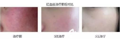 沈阳名流K8舒敏之星治疗红血丝真人前后效果对比